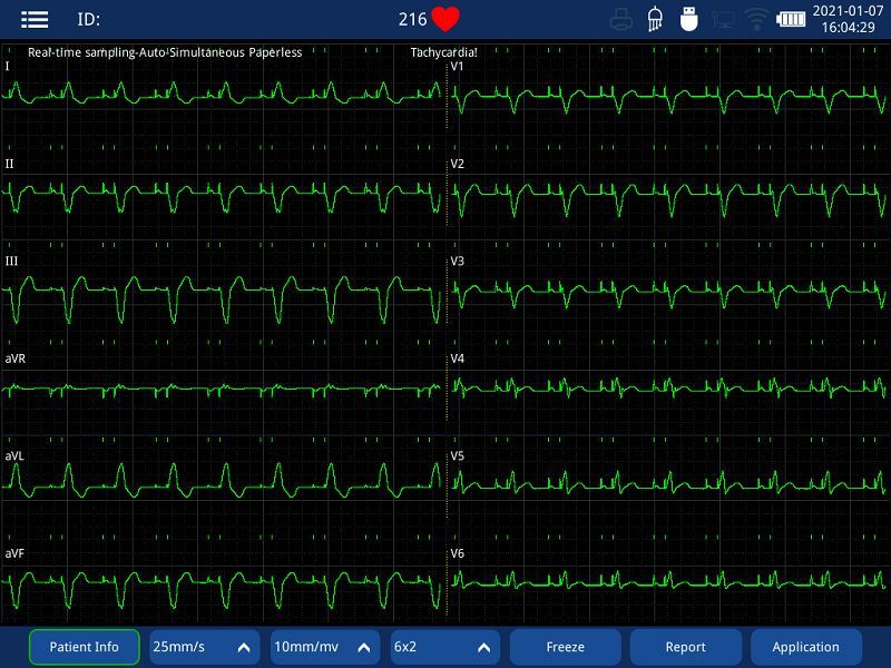 pace detection ECG machine(002)